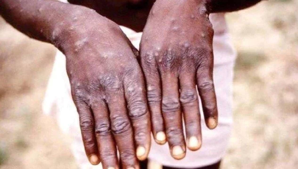 ganada m cicegi vaka sayisi 565e cikti 9ZkLqPDQ